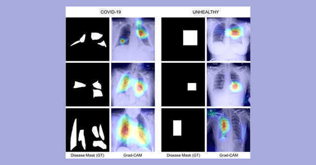 IIT researchers use AI to detect covid-19 through chest X-rays